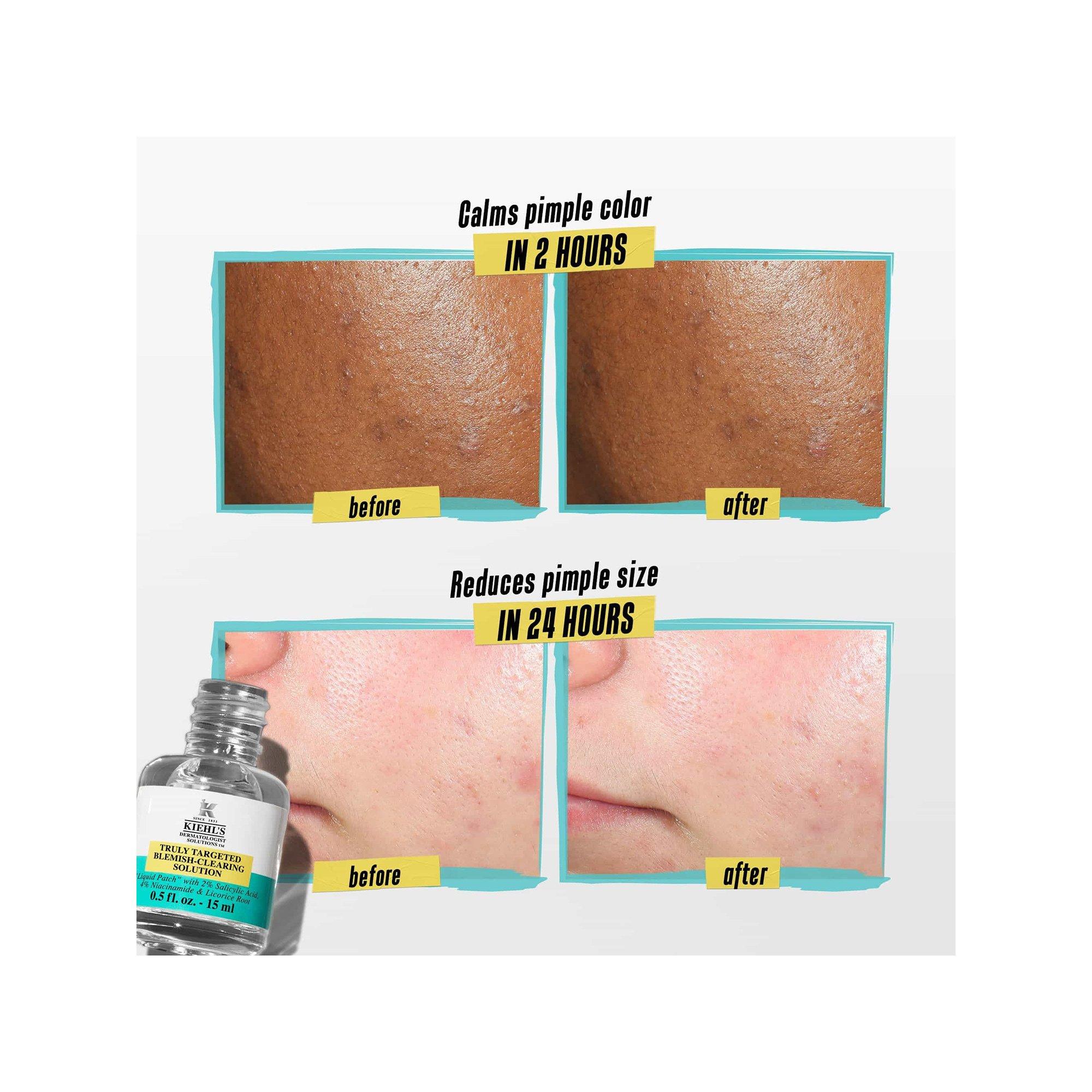 Kiehl's Truly Targeted Blemish-Clearing Solution